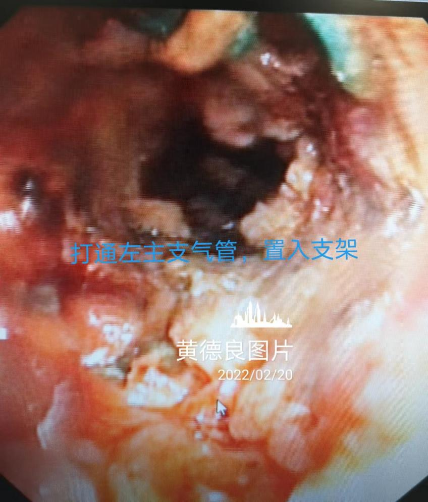 Open the left main bronchus and insert the stent Open the left main bronchus and insert the stent