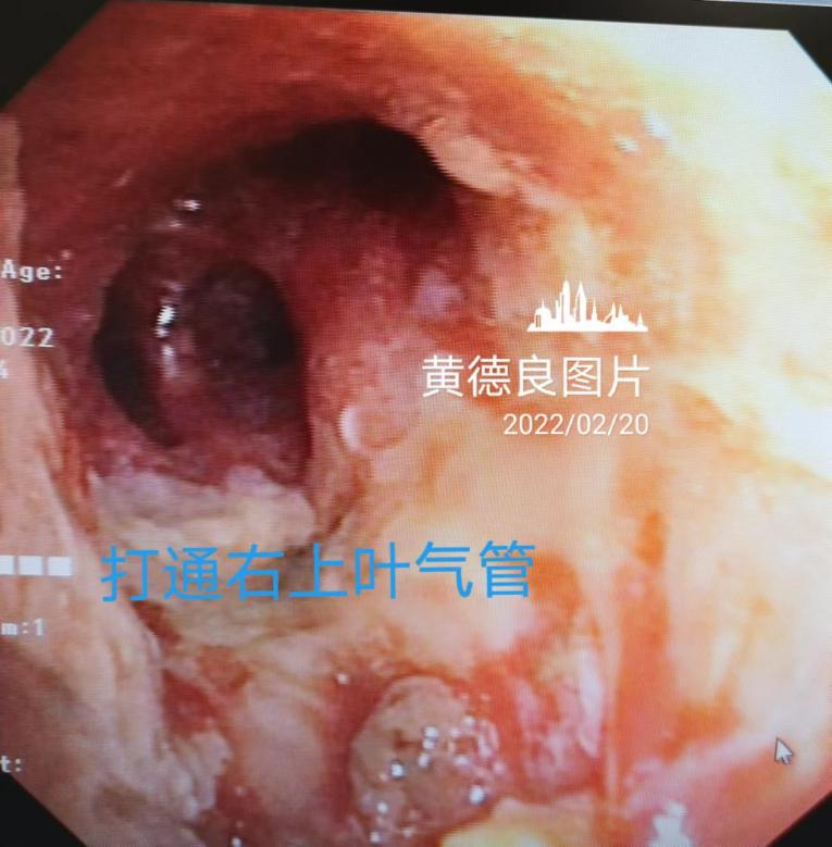 Open the right main bronchus Open the right main bronchus